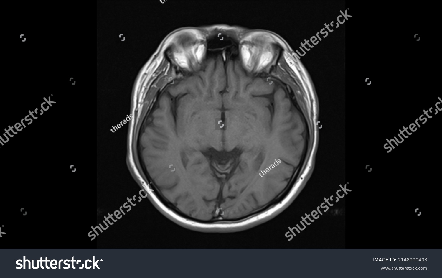 Normal Brain Anatomy Axial T1weighted Mri Stock Photo 2148990403 ...