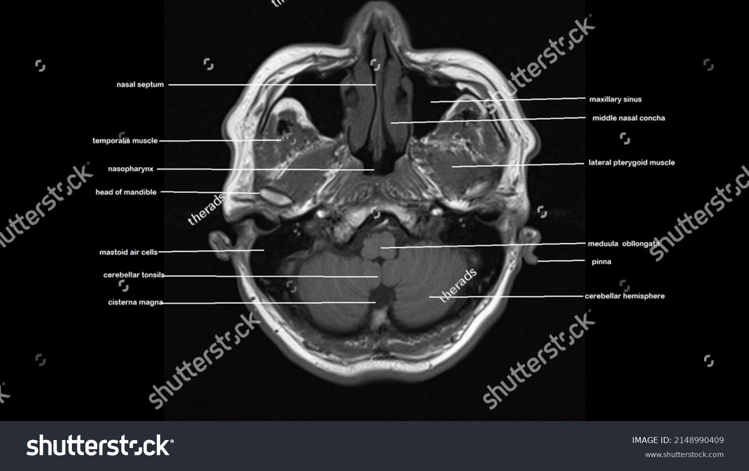 Normal Brain Anatomy Axial T1weighted Mri Stock Photo 2148990409 ...