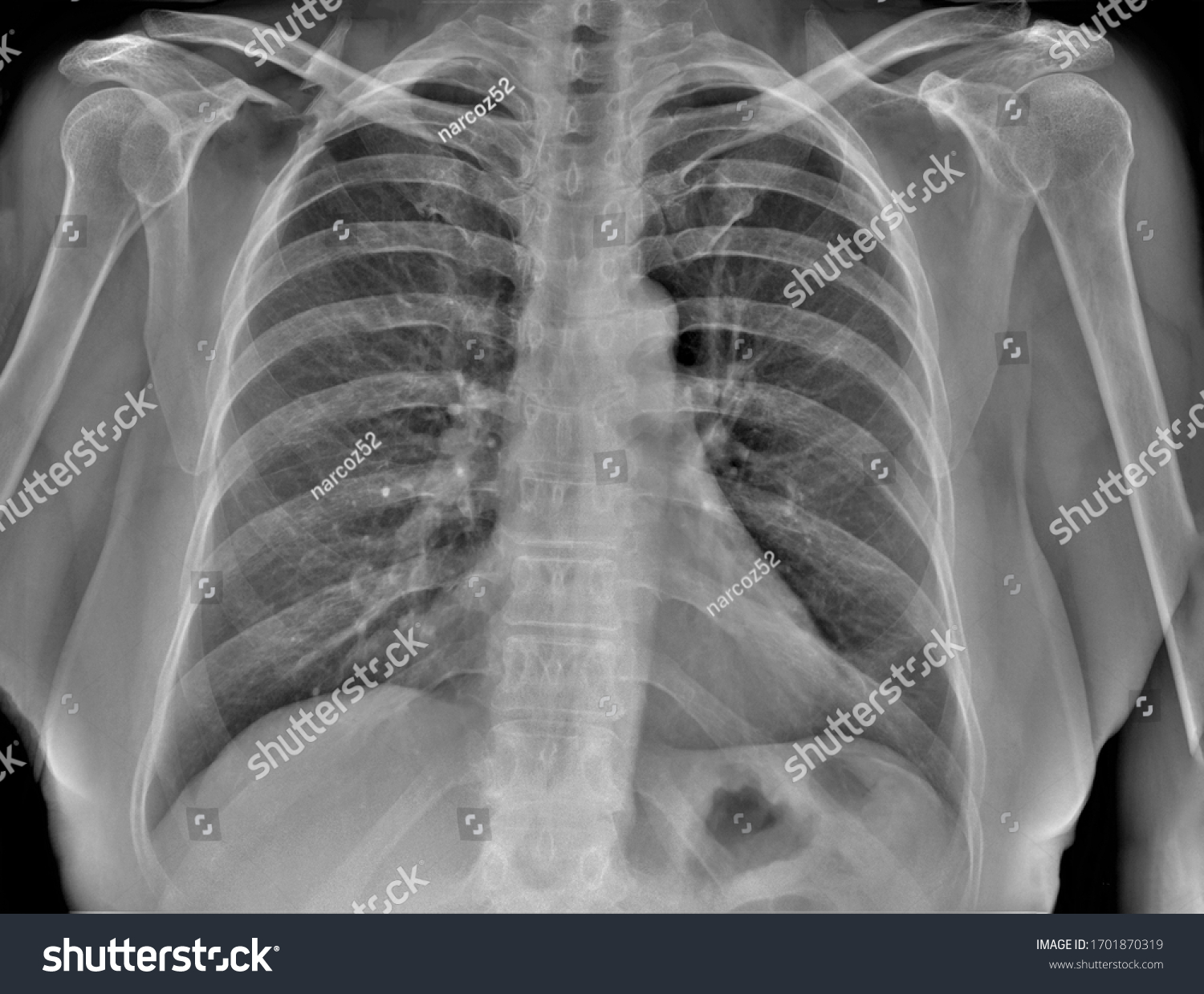 Normal Chest Xray Diagnosis Pneumonia Stock Photo 1701870319 | Shutterstock