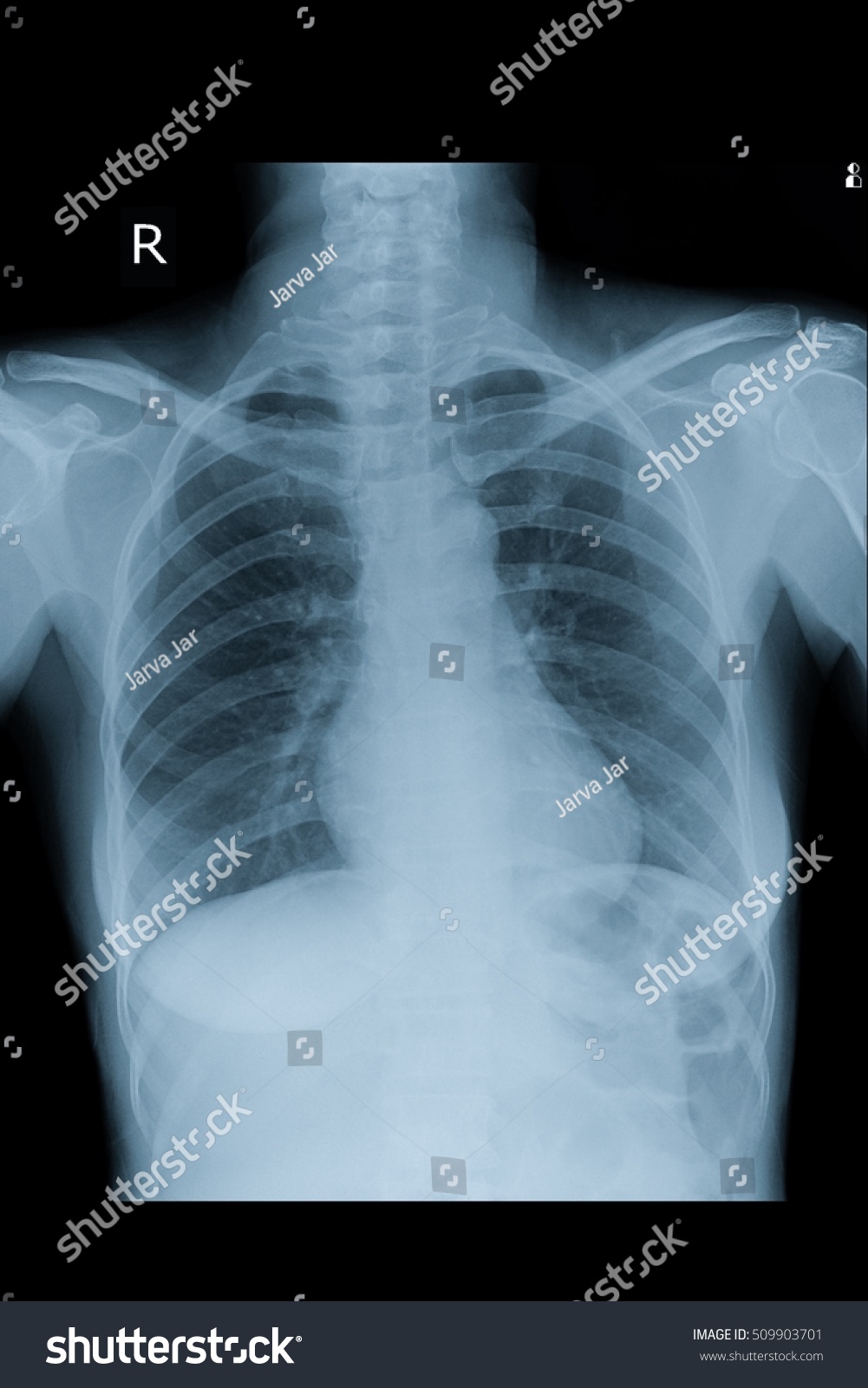 Normal Chest Xray In Adult Stock Photo 509903701 Shutterstock