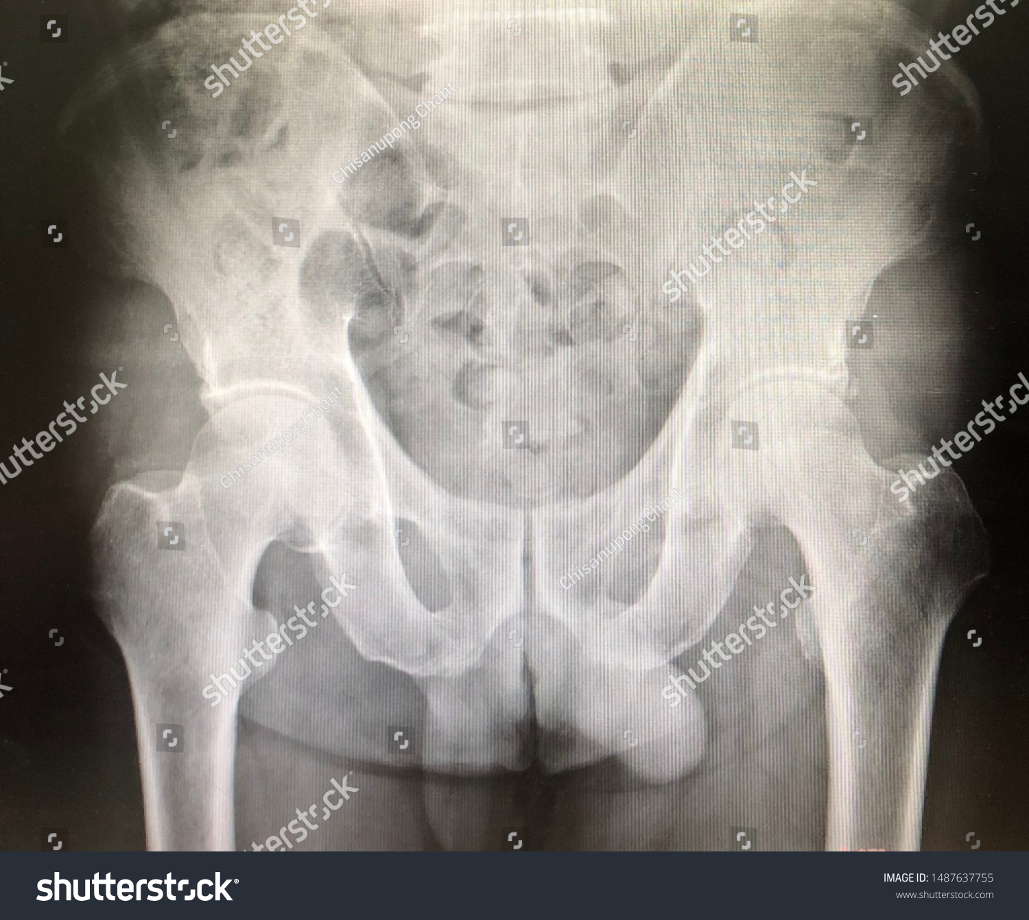 Diagram Showing Standardised Positioning For Ap Pelvic Radiographs For Download Scientific Diagram