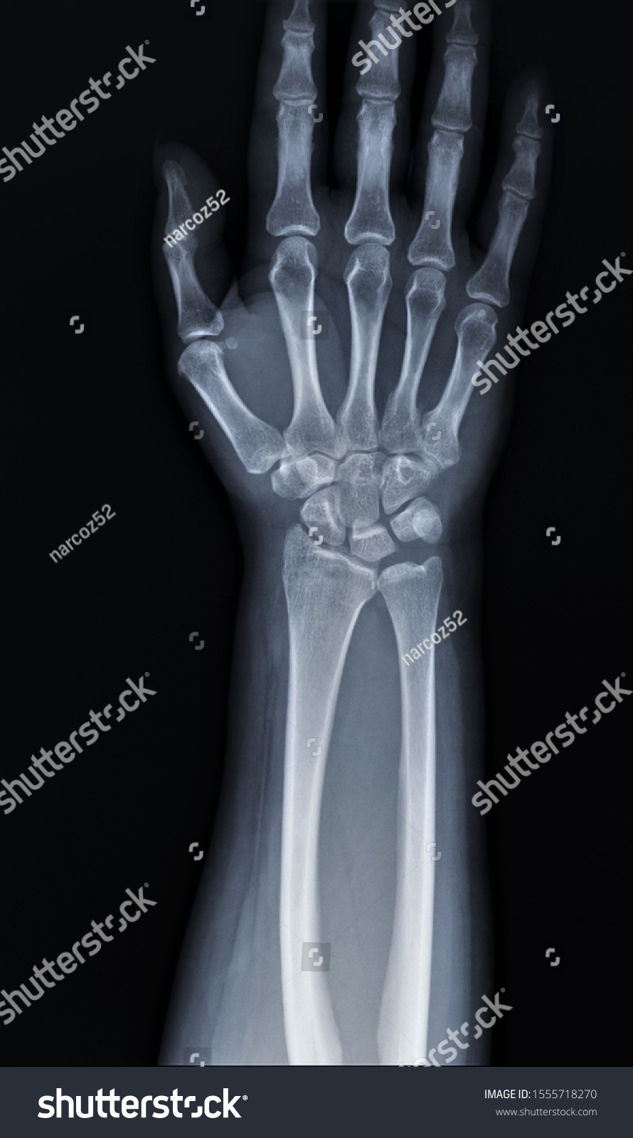 Normal Radiography Hand Wrist Bones Traumatology Stock Photo 1555718270 ...