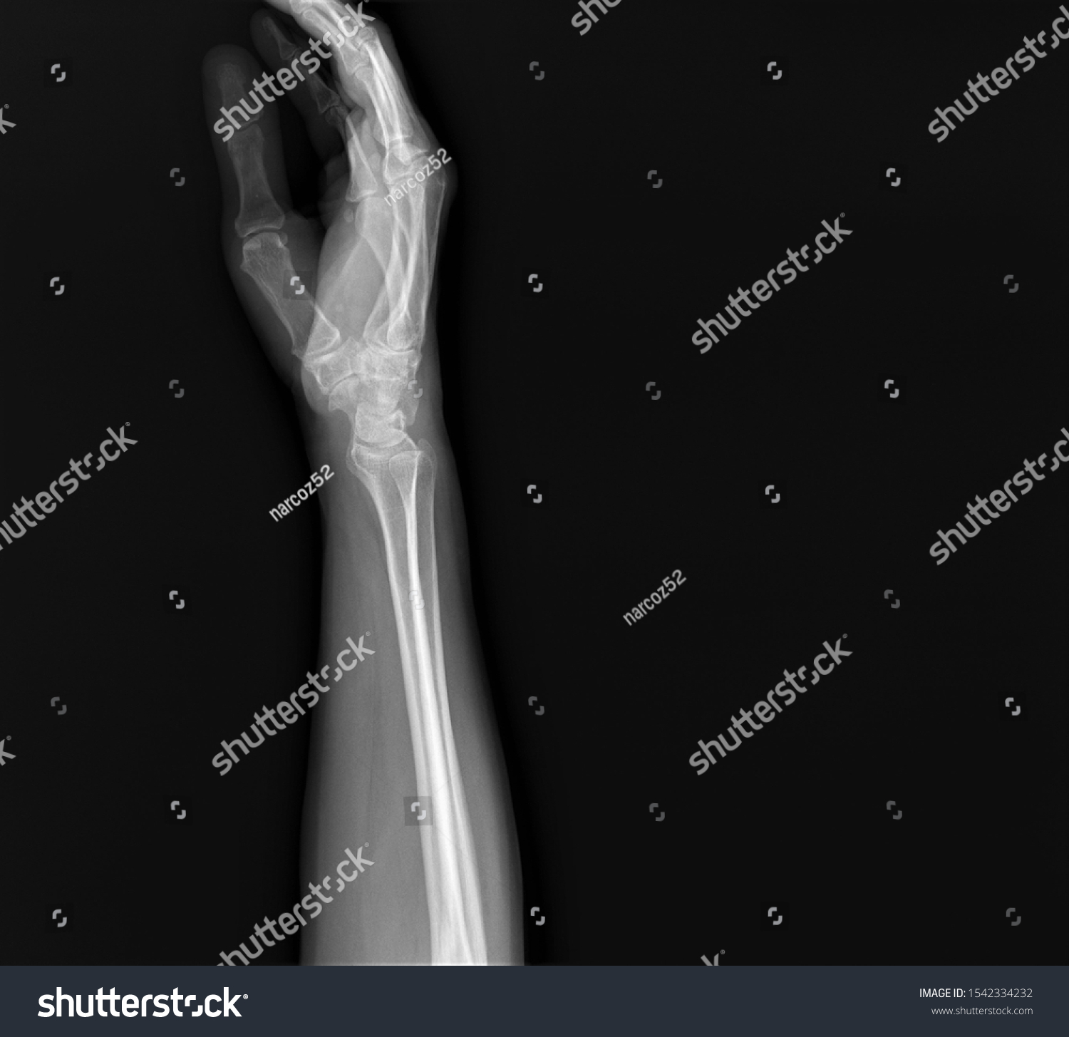 Normal Radiography Hand Wrist Bones Traumatology Stock Photo 1542334232 ...