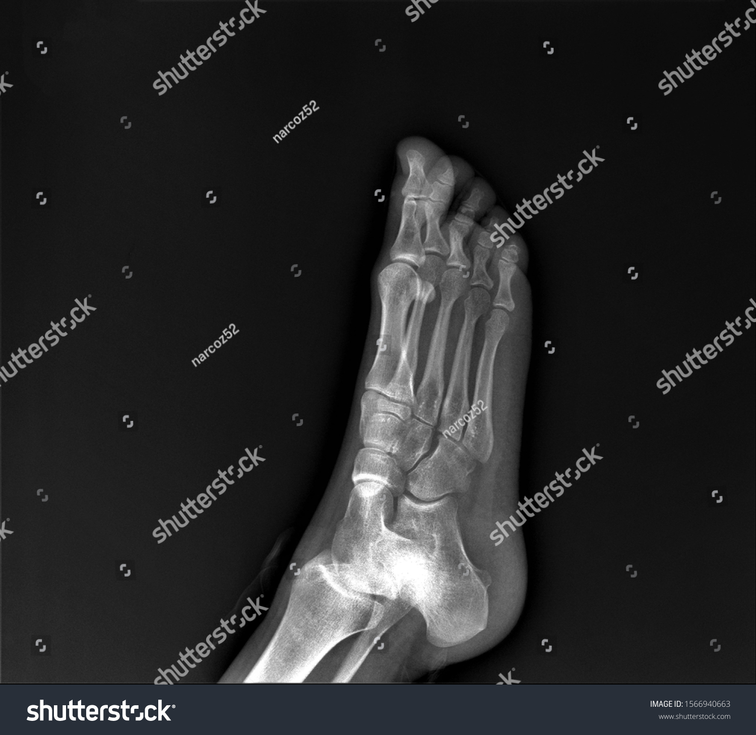 Normal Radiography Foot Medical Diagnostics Traumatology Stock Photo ...