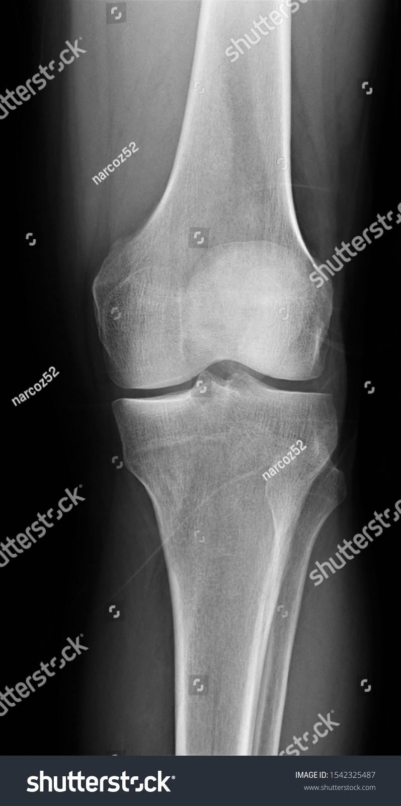 Normal Radiography Knee Joint Direct Projection Stock Photo 1542325487 ...