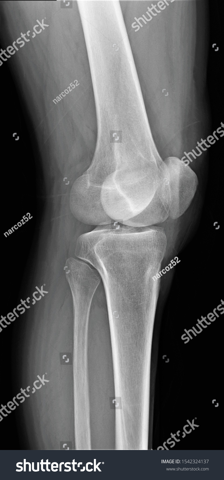 Normal Radiography Knee Joint Lateral Projection Stock Photo 1542324137 ...