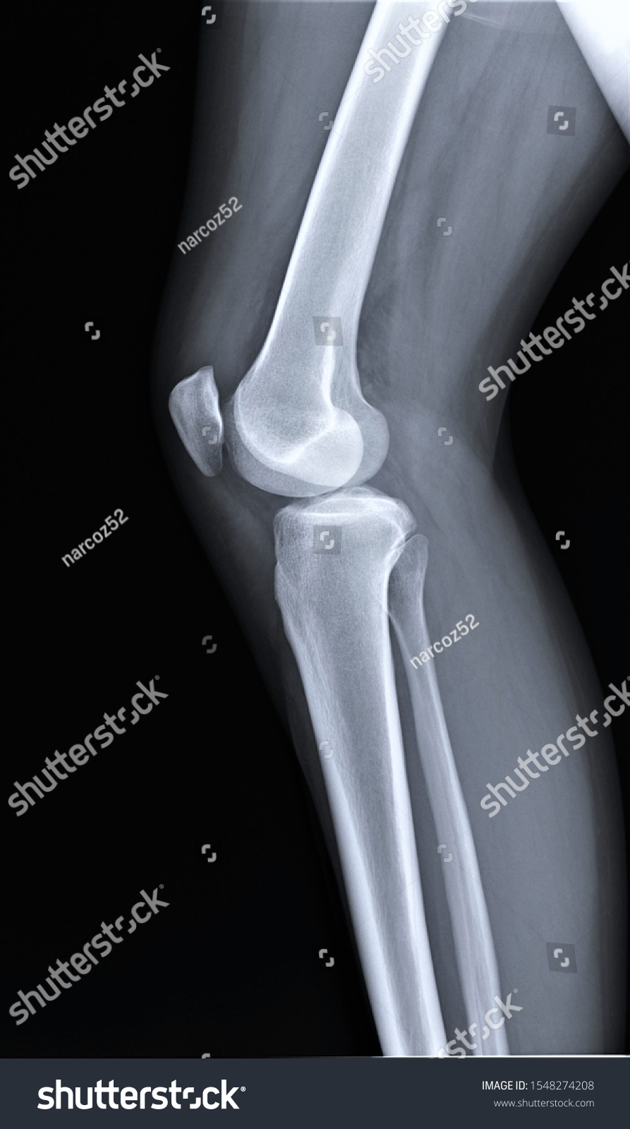 Normal Radiography Knee Joint Lateral Projection Stock Photo 1548274208 