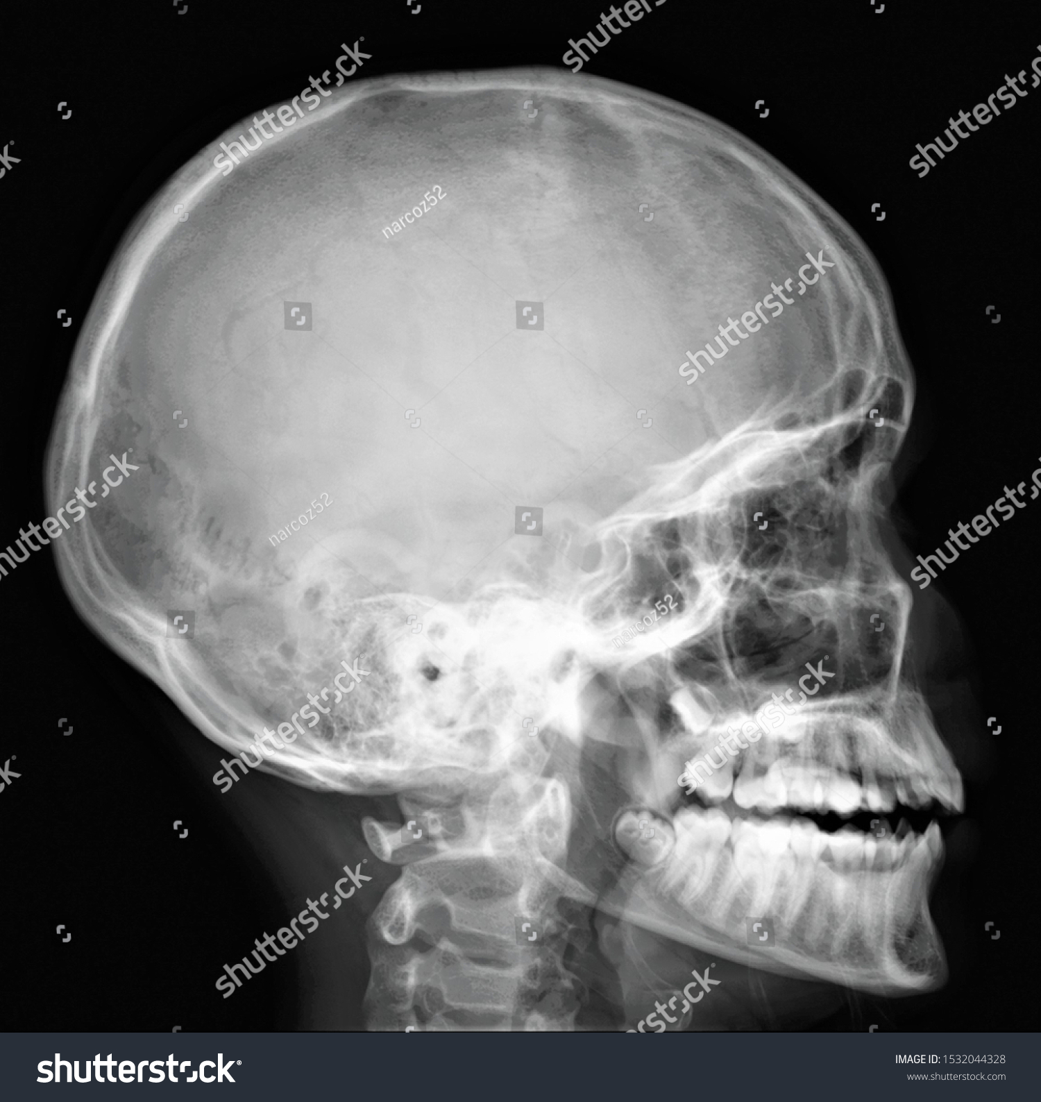 Normal Xray Skull Lateral Projection Stock Photo 1532044328 | Shutterstock