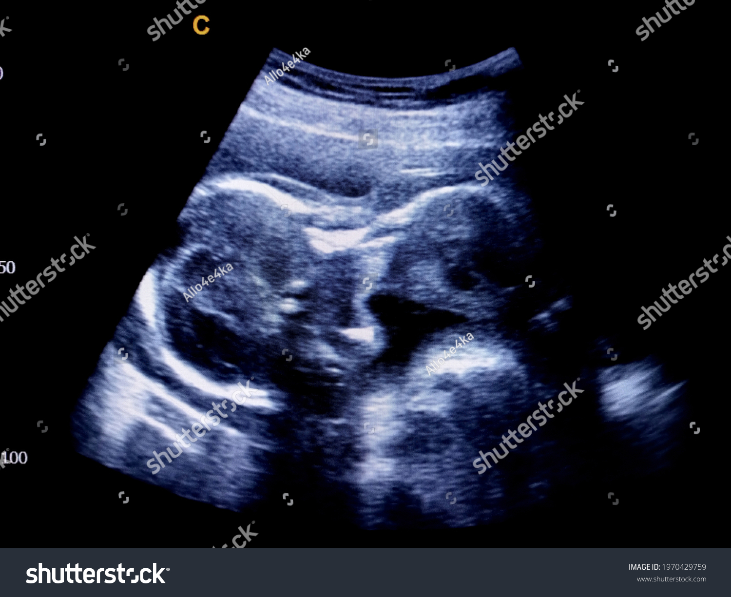 Nuchal thickness ultrasound
