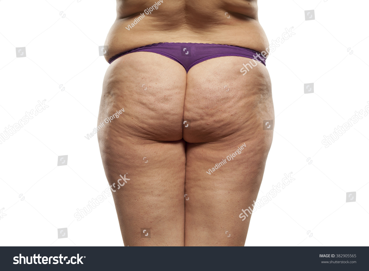 stock-photo-obese-female-buttocks-with-cellulite-and-stretch-marks-382905565.jpg