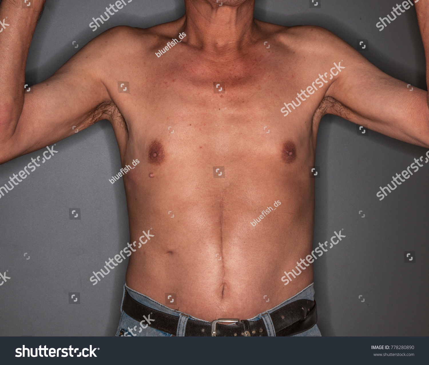 Old Man Body Operation Scar On Stock Photo 778280890 | Shutterstock