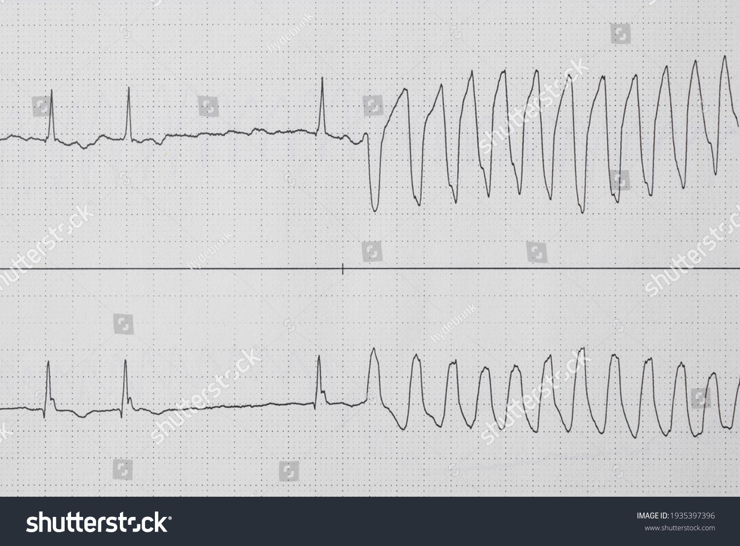 Onset Ventricular Tachycardia Stock Photo (edit Now) 1935397396