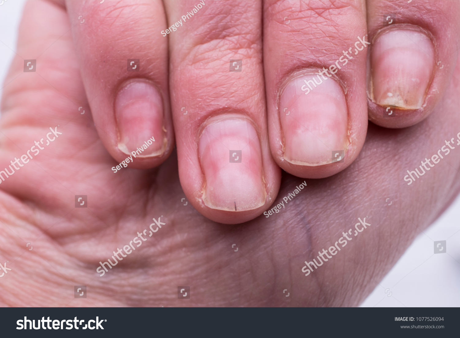 190 Onychomadesis Images, Stock Photos & Vectors | Shutterstock