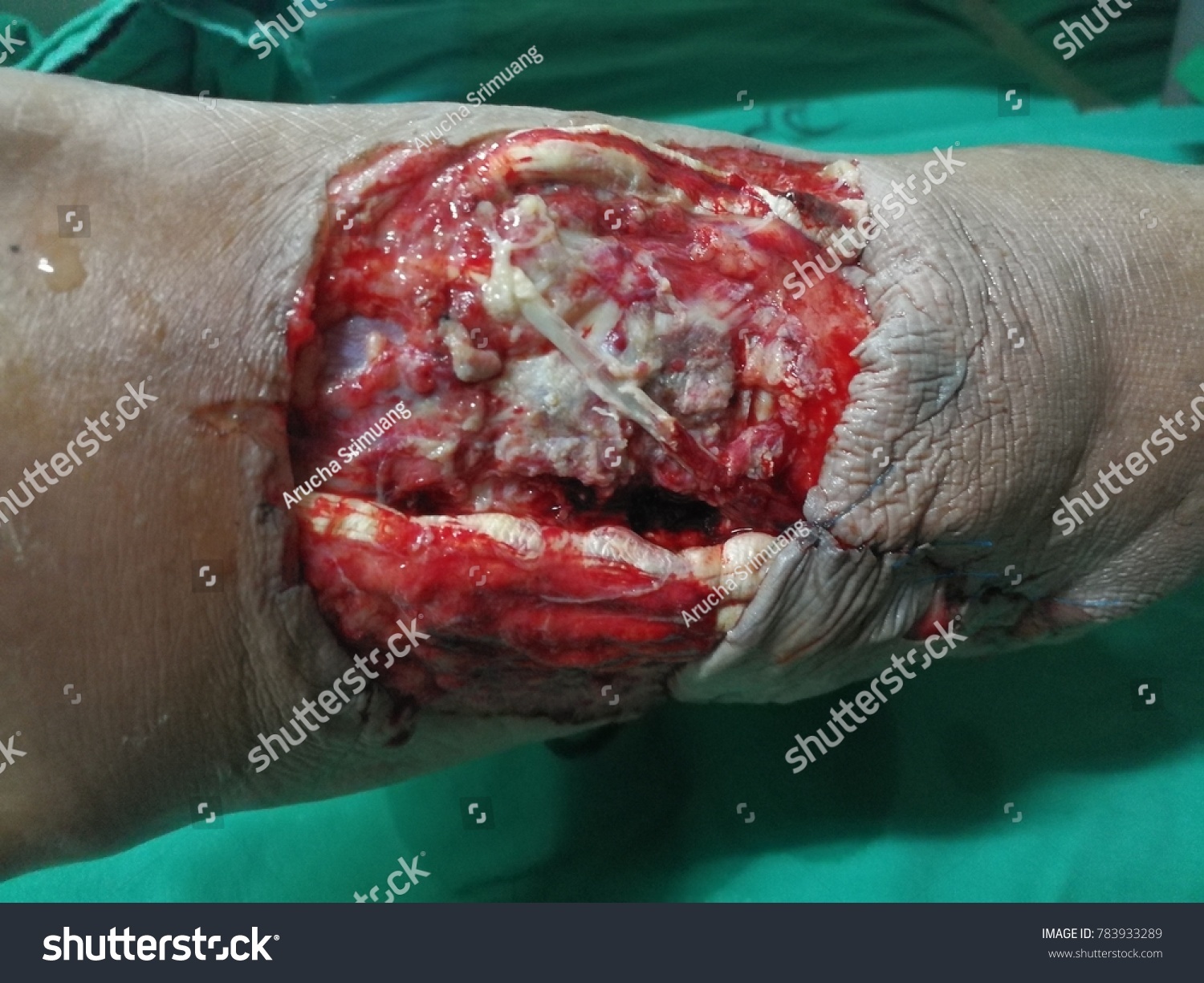https://image.shutterstock.com/z/stock-photo-open-wound-and-tendon-injury-783933289.jpg
