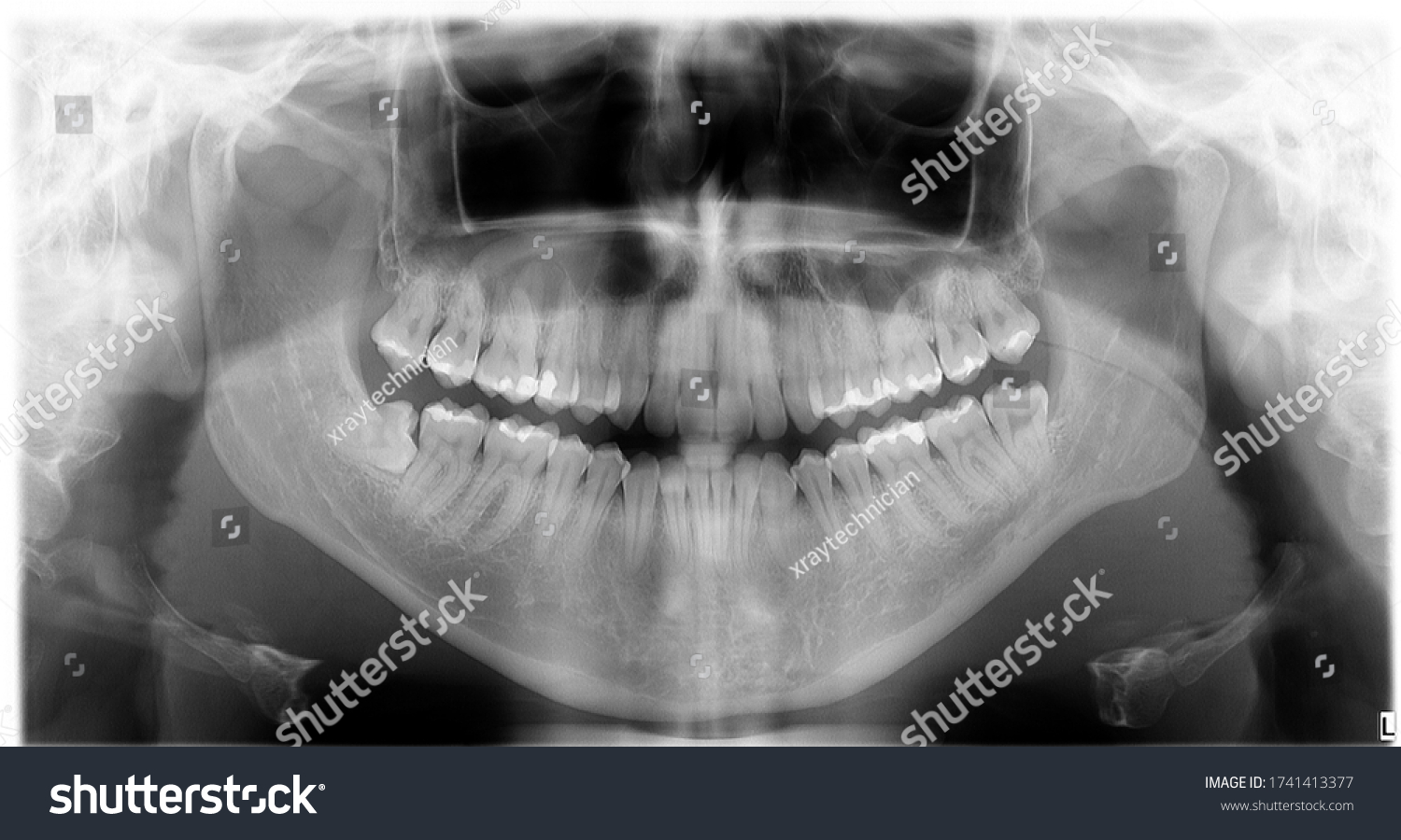 Opg Orthopantomography Dental Xray Tooth Stock Photo (Edit Now) 1741413377