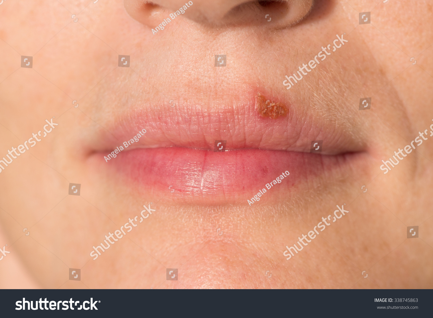 Oral Herpes Rash at Jacqueline Gean blog