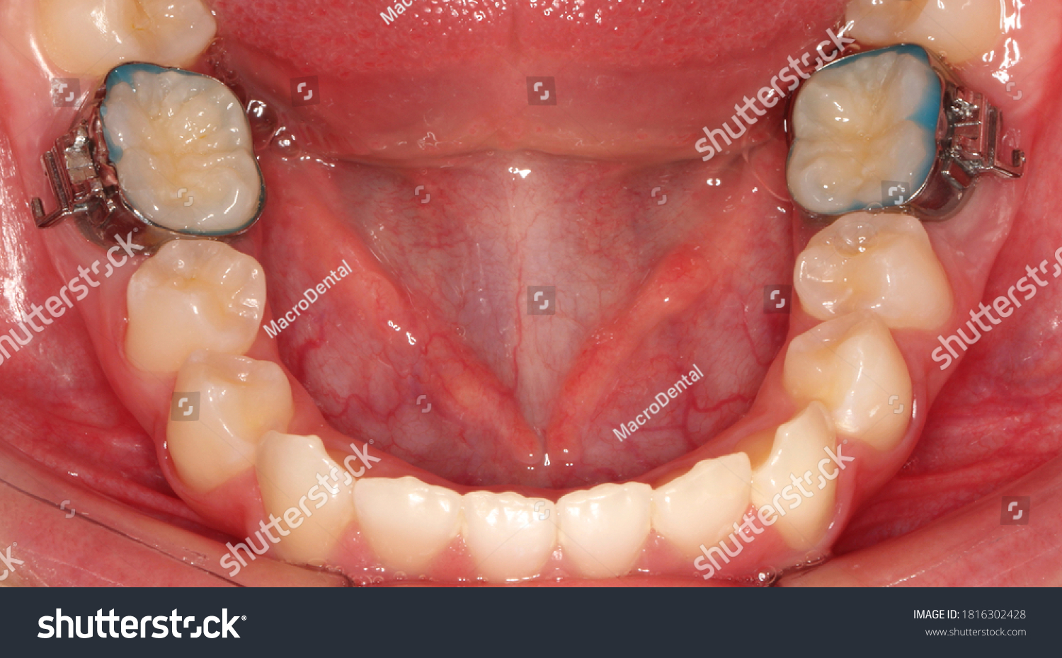 111 Molar bands Images, Stock Photos & Vectors Shutterstock