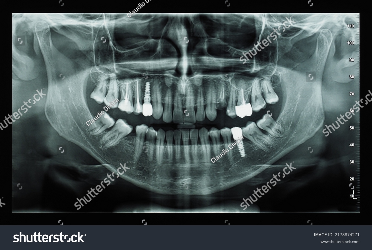 Orthopantomogram Single Panoramic Image Radiograph Mandible Stock Photo ...