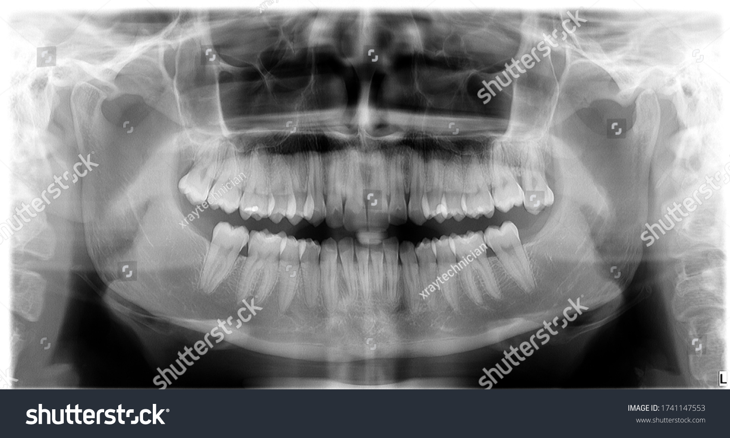 Orthopantomography Opg Tooth Dental Xray Stock Photo 1741147553 ...