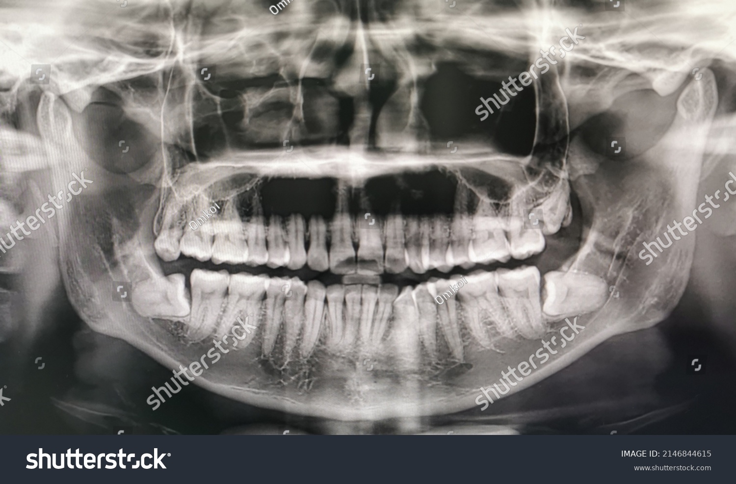 Orthopantomography Opg Xray Dr Digital Wisdom Stock Photo 2146844615 ...