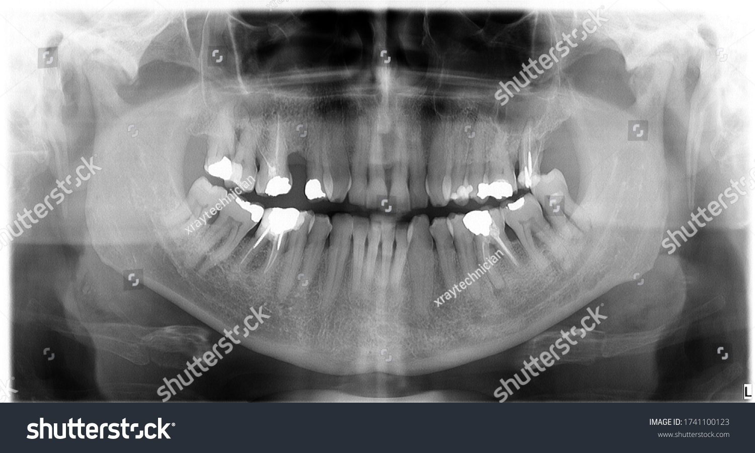 Ortopanthomografy Opg Xray Tooth Dental Stock Photo (Edit Now) 1741100123