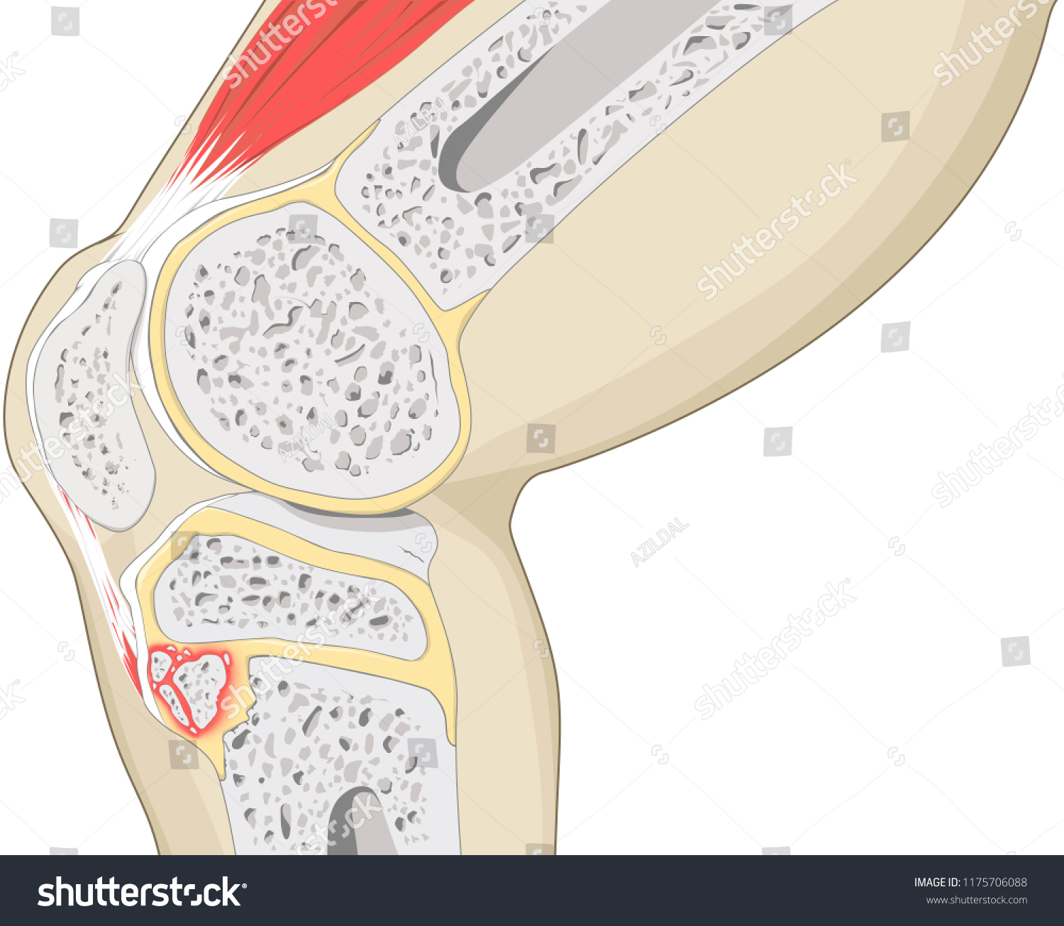 Osgood Schlatter Disease Diagram Knee Anatomy Stock Illustration 1175706088