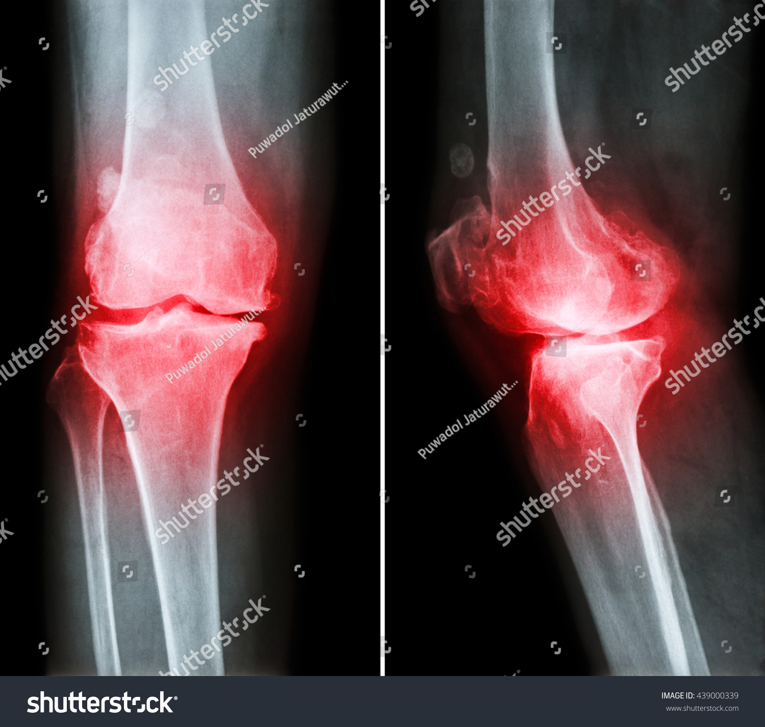 Osteoarthritis Knee Film Xray Knee Anterior Stock Photo 439000339 ...