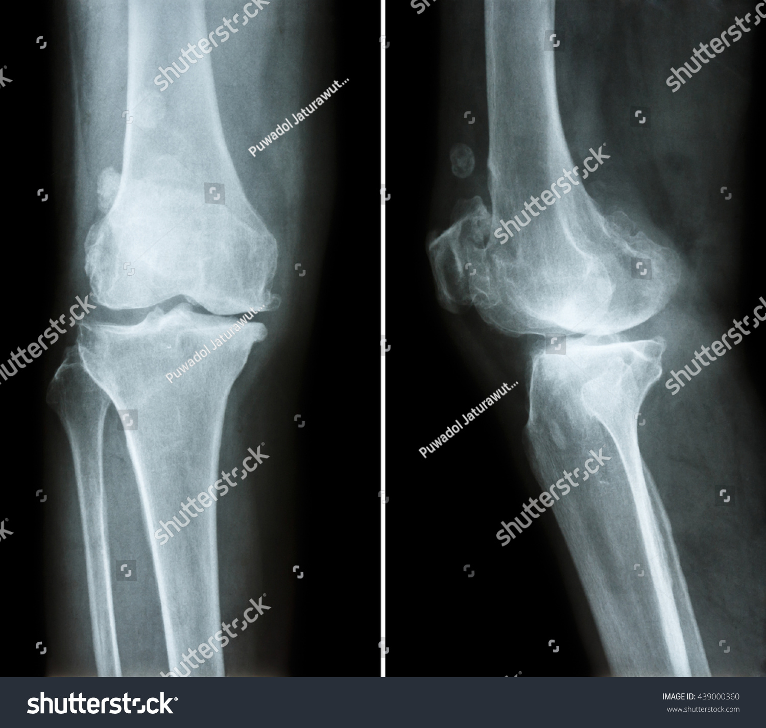 Osteoarthritis Knee Film Xray Knee Anterior Stock Photo 439000360 ...