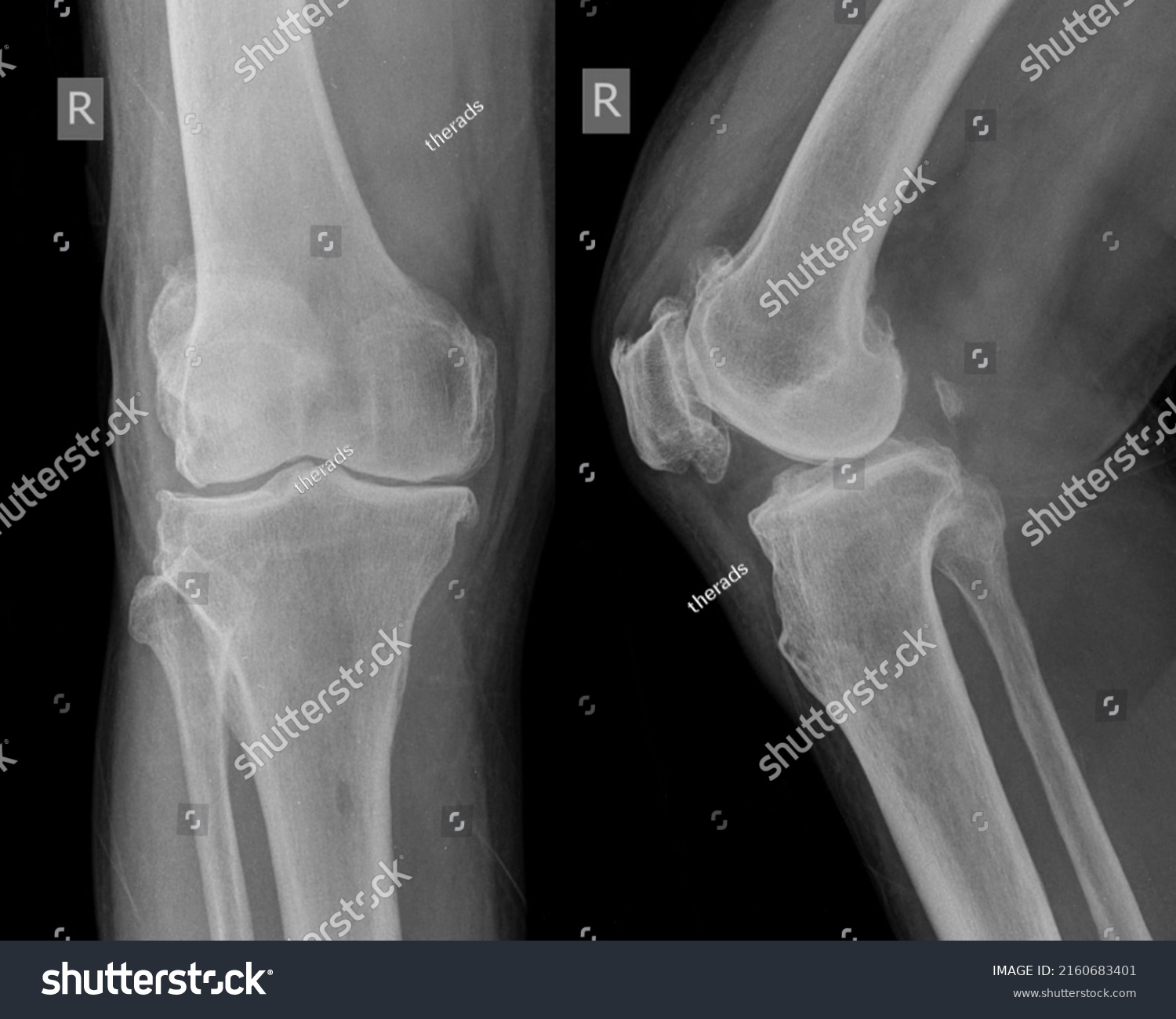 Osteoarthritis Knee Show Narrow Joint Space Stock Photo 2160683401 ...