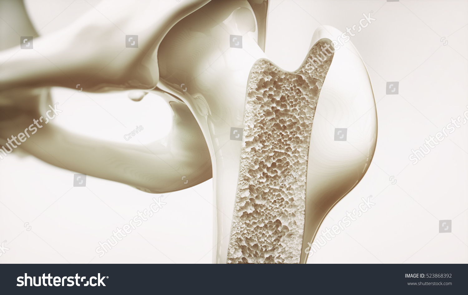 osteoporosis-stage-3-4-upper-limb-stock-illustration-523868392