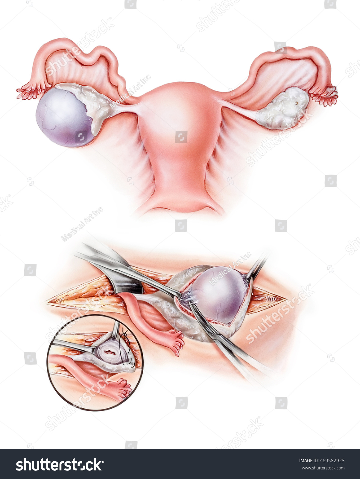 Eierstokken Cystectomie Chirurgie Om Een Stockillustratie 469582928