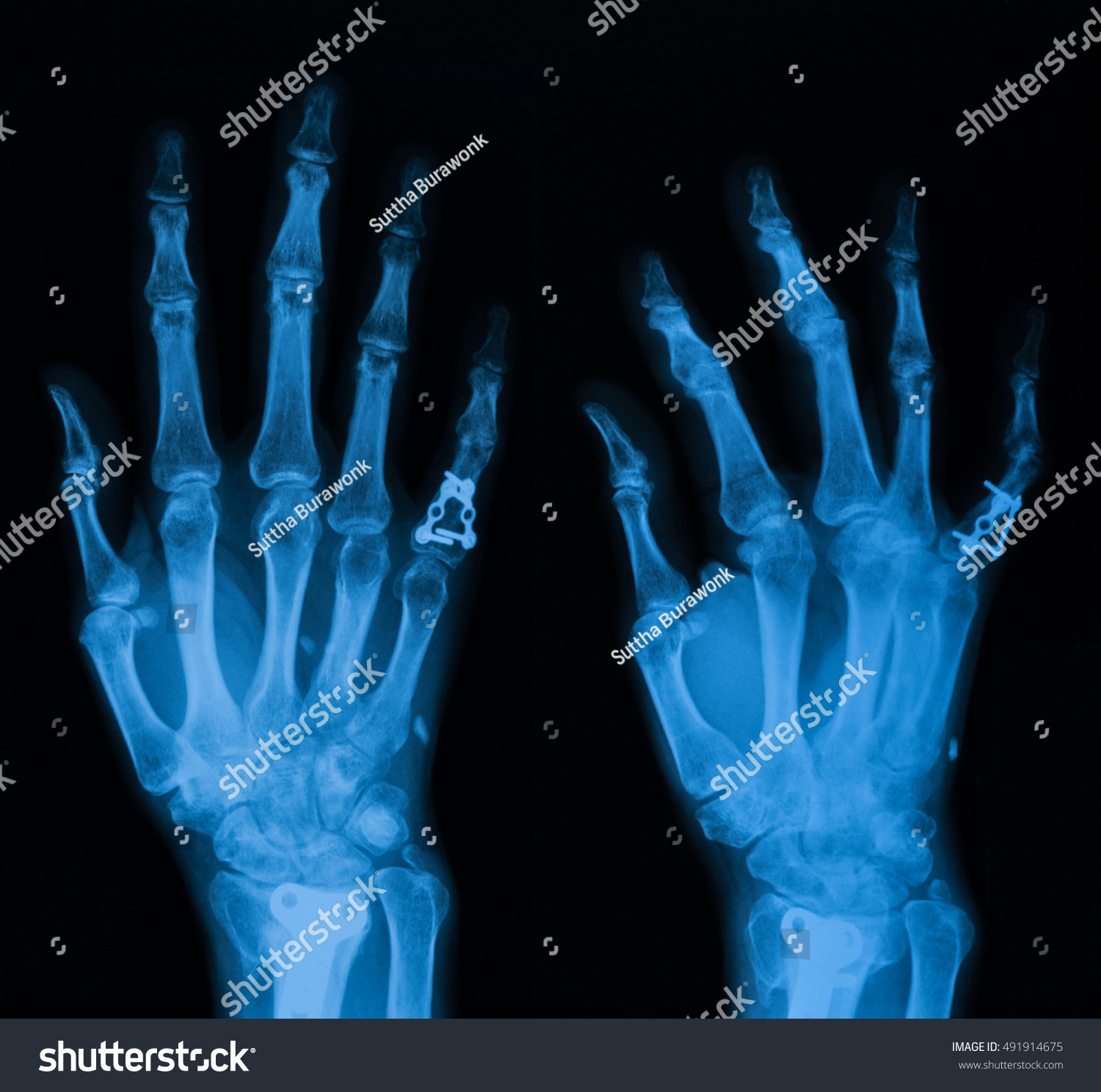 Pa Oblique Views Hand Include Wrist Stock Photo 491914675 - Shutterstock