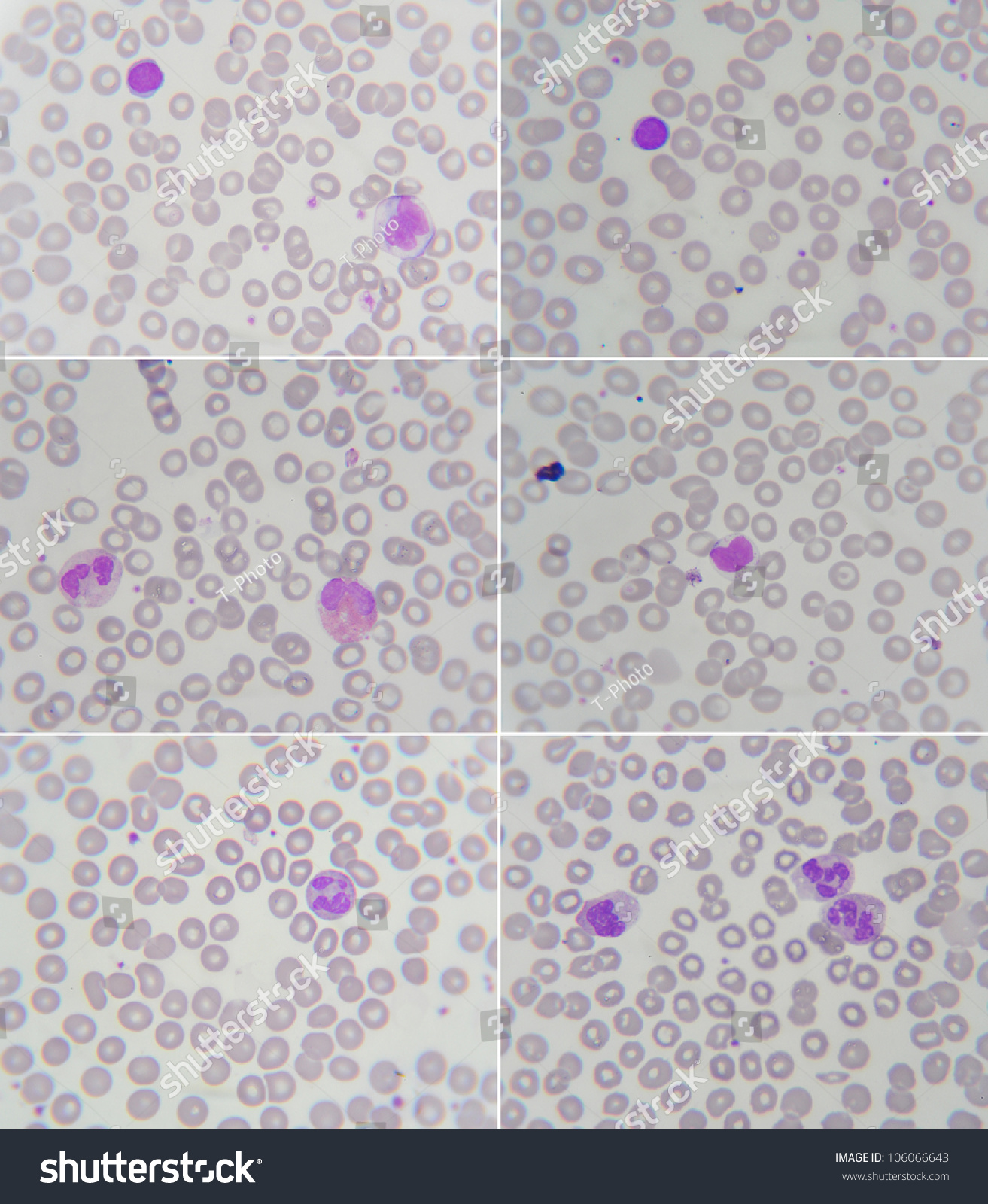 Package Of Blood Smear Show Neutrophil , Lymphocyte , Monocyte ...