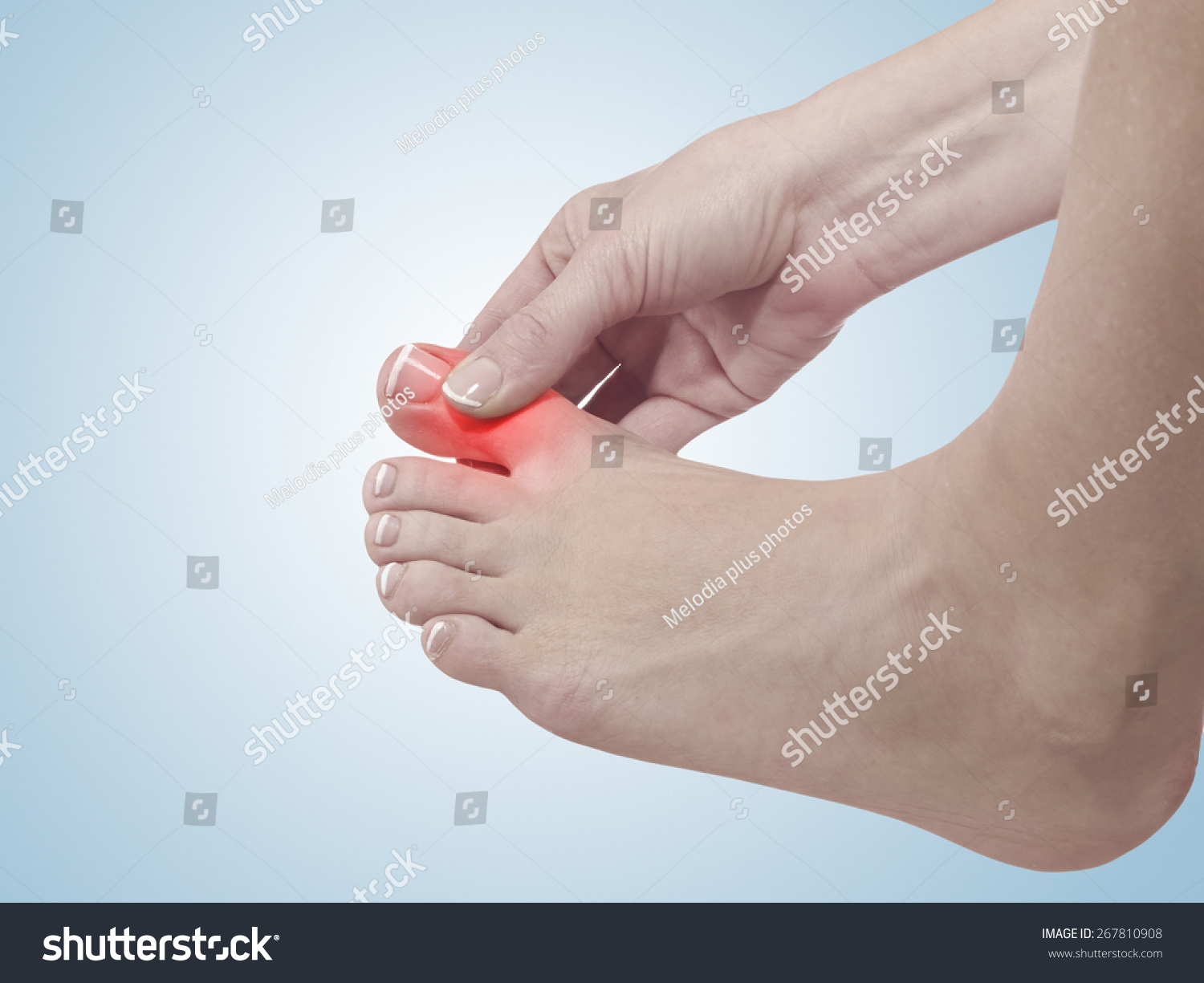 Painful And Inflamed Gout On His Foot Around The Big Toe Area. Stock ...