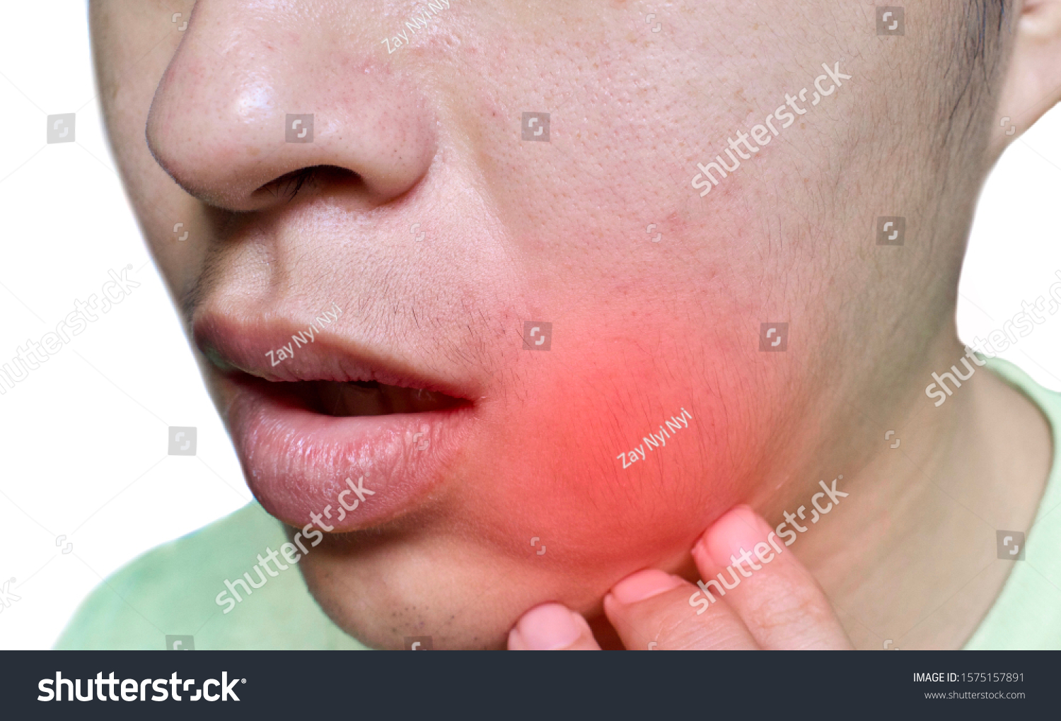 painful-cheek-swelling-dental-abscess-lower-stockfoto-redigera-nu