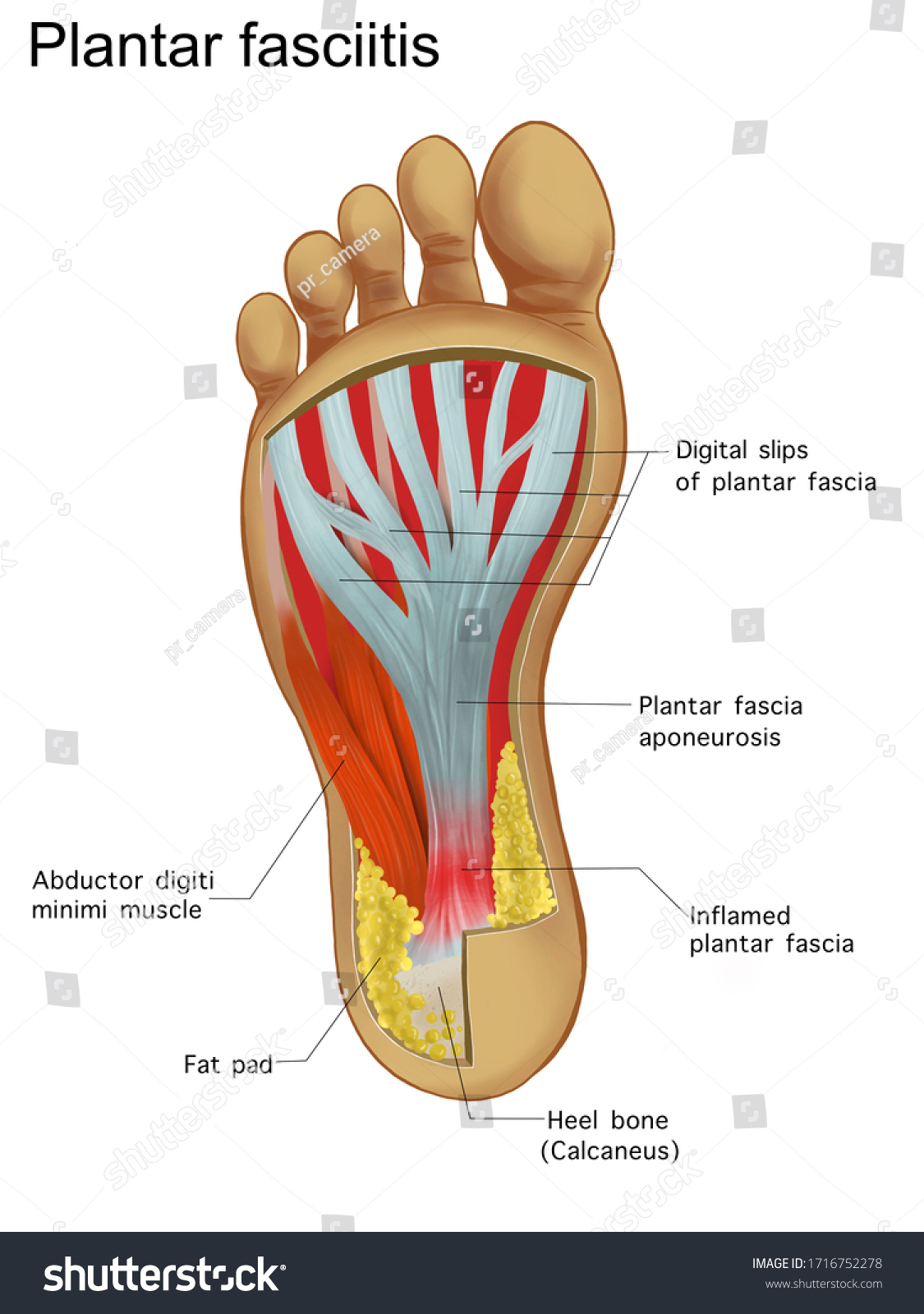 Painful Plantar Fasciitis Ligament Feet Disorder Stock Illustration ...