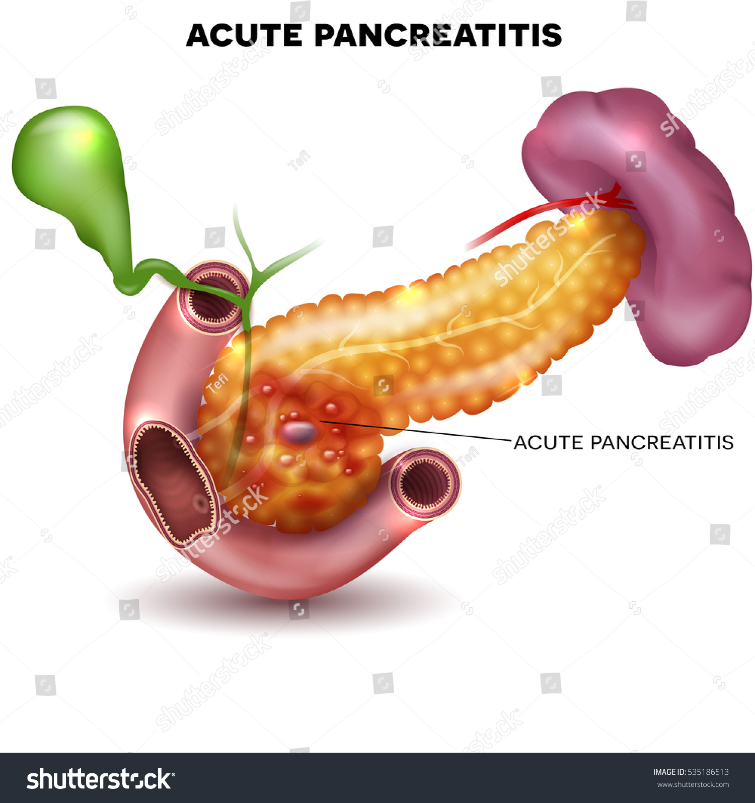 Pancreatitis Illustration Inflammation Pancreas Other Surrounding Stock ...