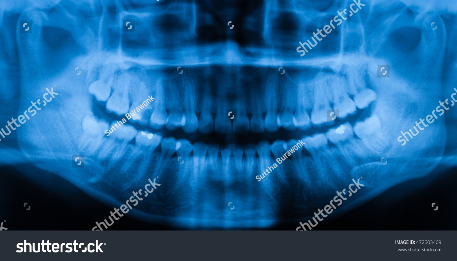 Panoramic Dental Mandible Xray Image Stock Photo 472503469 | Shutterstock