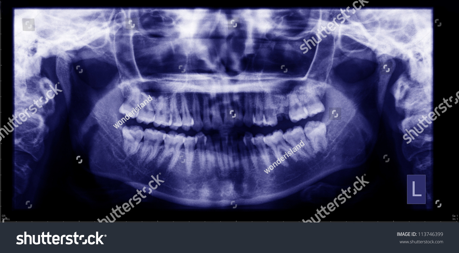 Panoramic Dental X-Ray Film Stock Photo 113746399 : Shutterstock