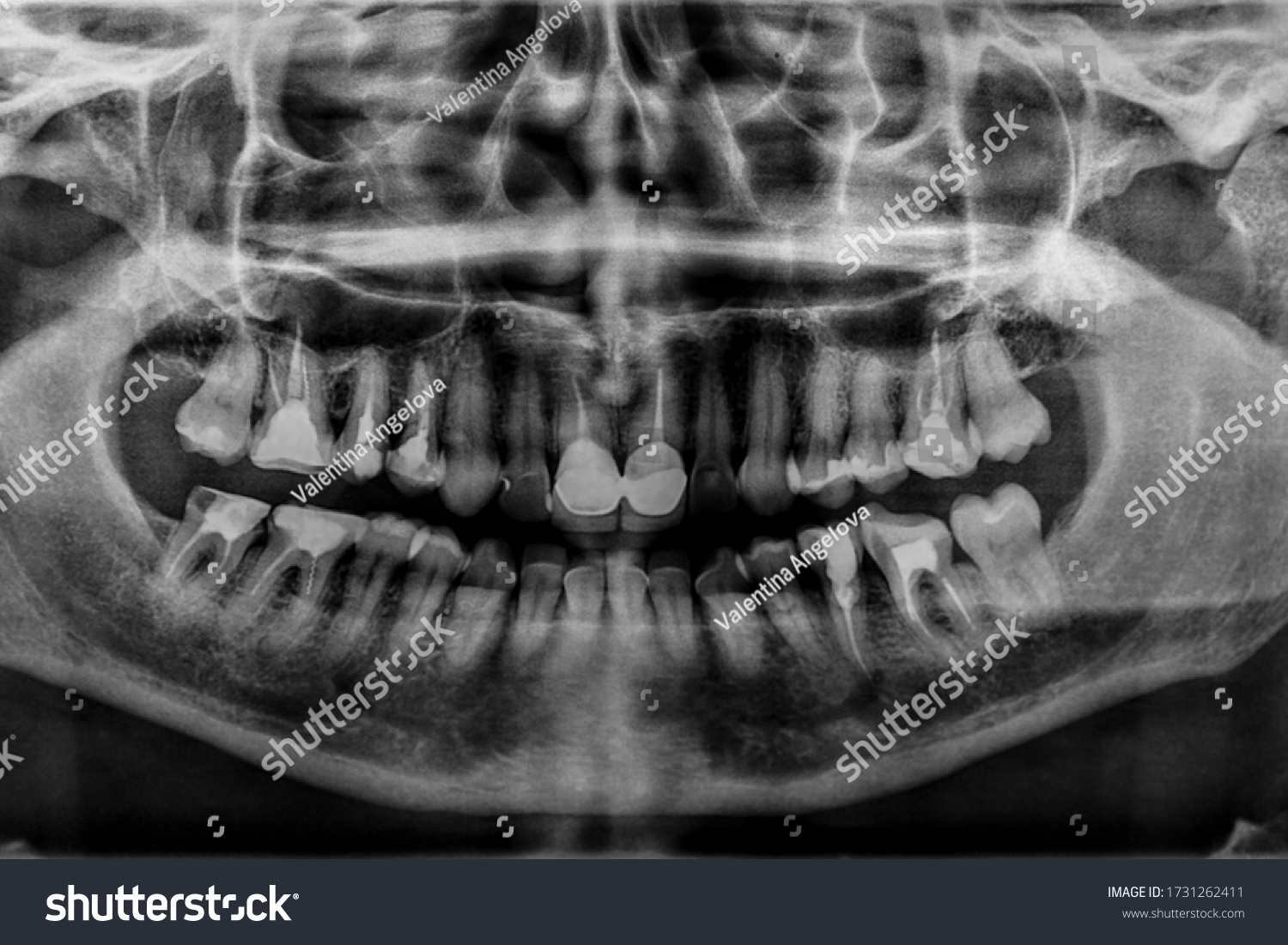 Panoramic Dental Xray Mouth Tooth Fillings Stock Photo (Edit Now ...