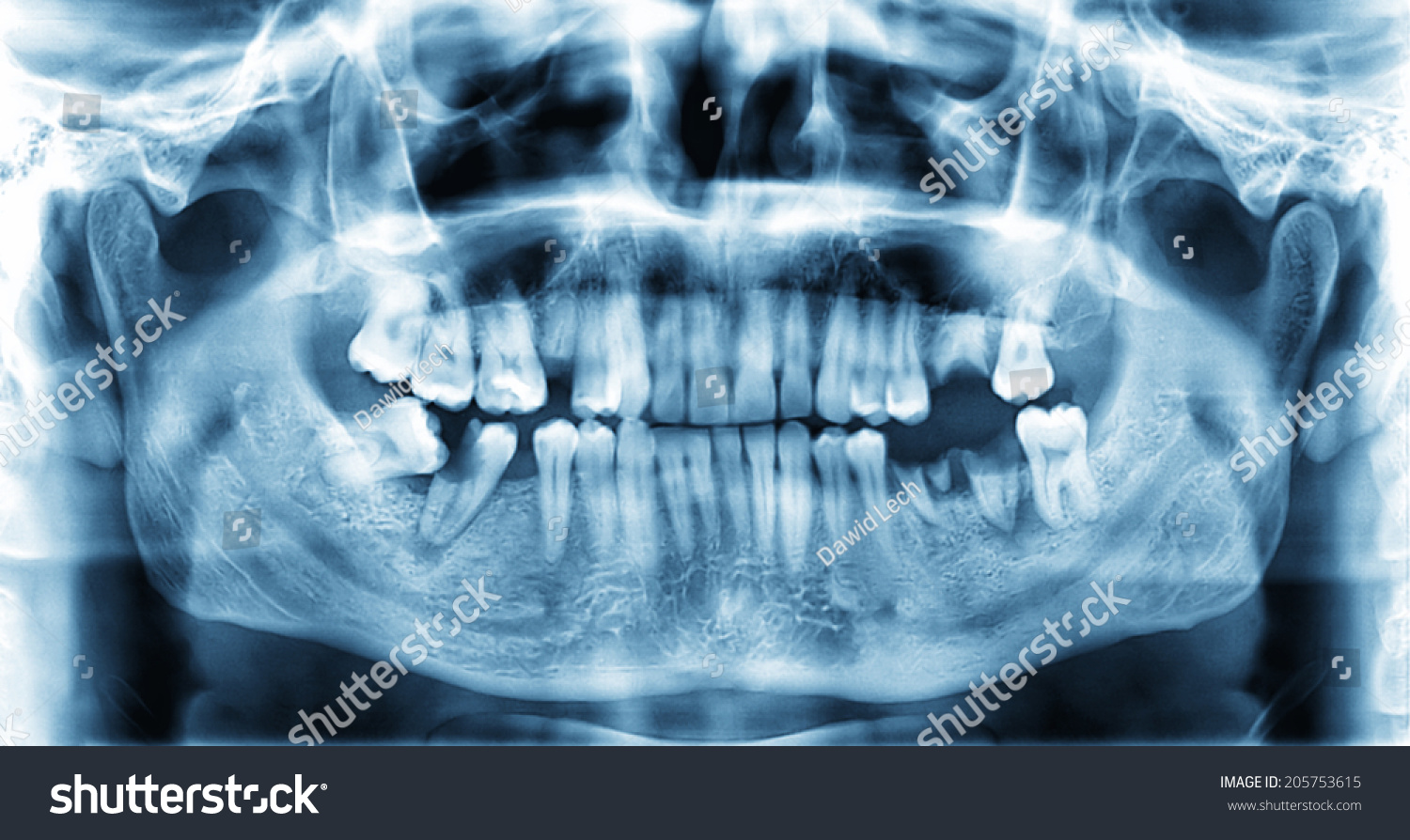 481 X ray teeth missing Images, Stock Photos & Vectors | Shutterstock