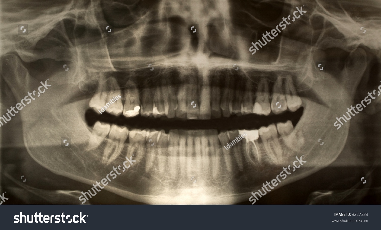 Panoramic Dental X-Ray Of A Young Adult Male Stock Photo 9227338 ...