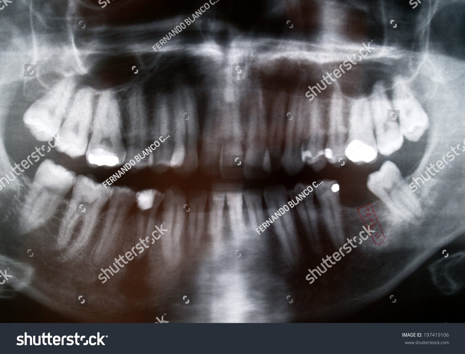 Panoramic Dental Xray Study One Missing Stock Photo (Edit Now) 197419106