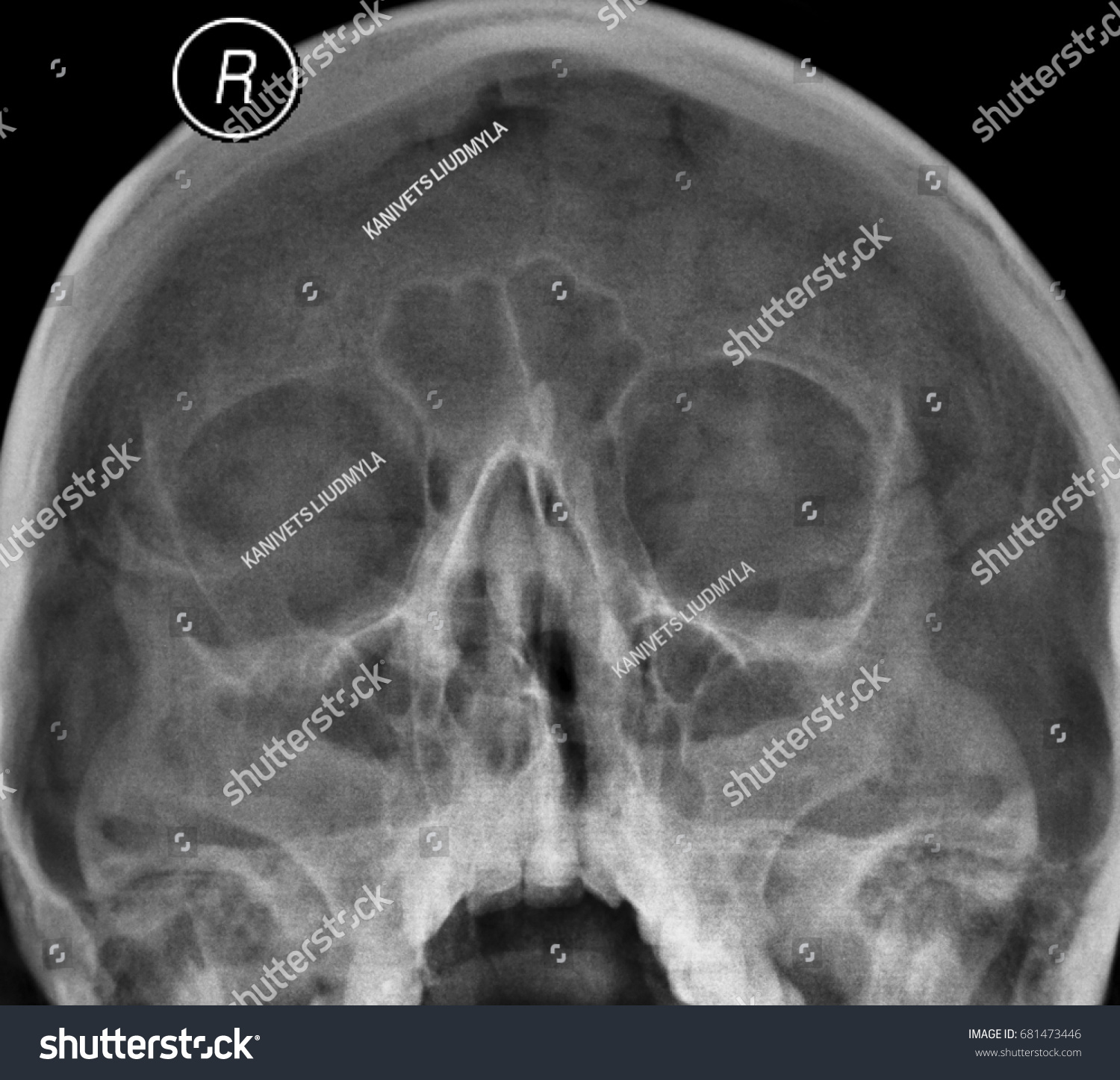 4-pansinusitis-shutterstock