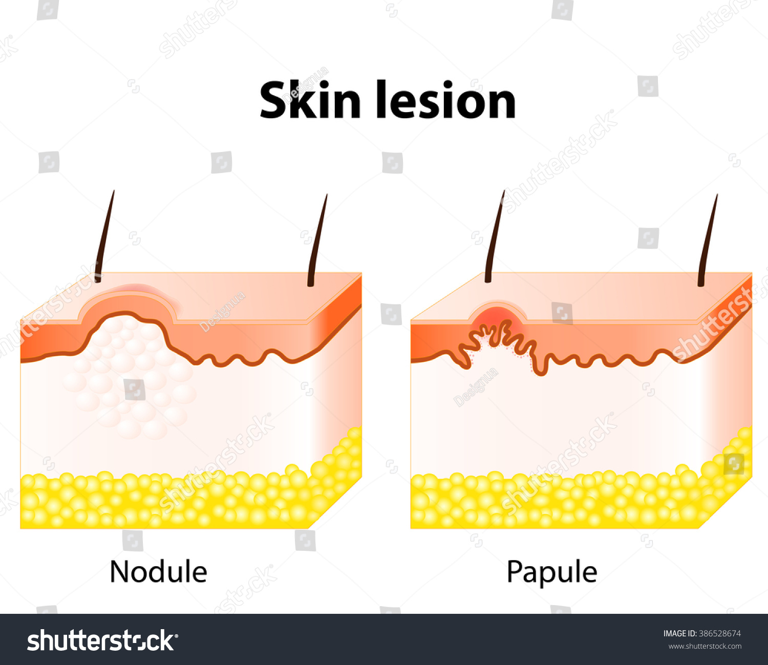 Papule Nodule Skin Lesion Stock Illustration 386528674 - Shutterstock