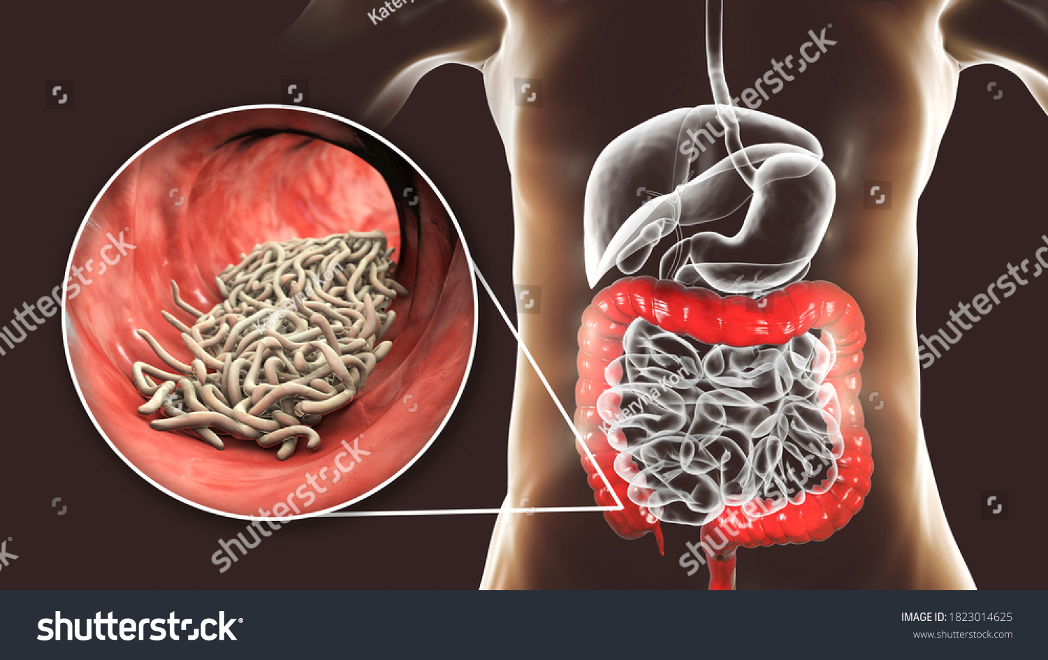 Infección Por Parásitos Intestinales - Síntomas Y Causas - Mayo Clinic