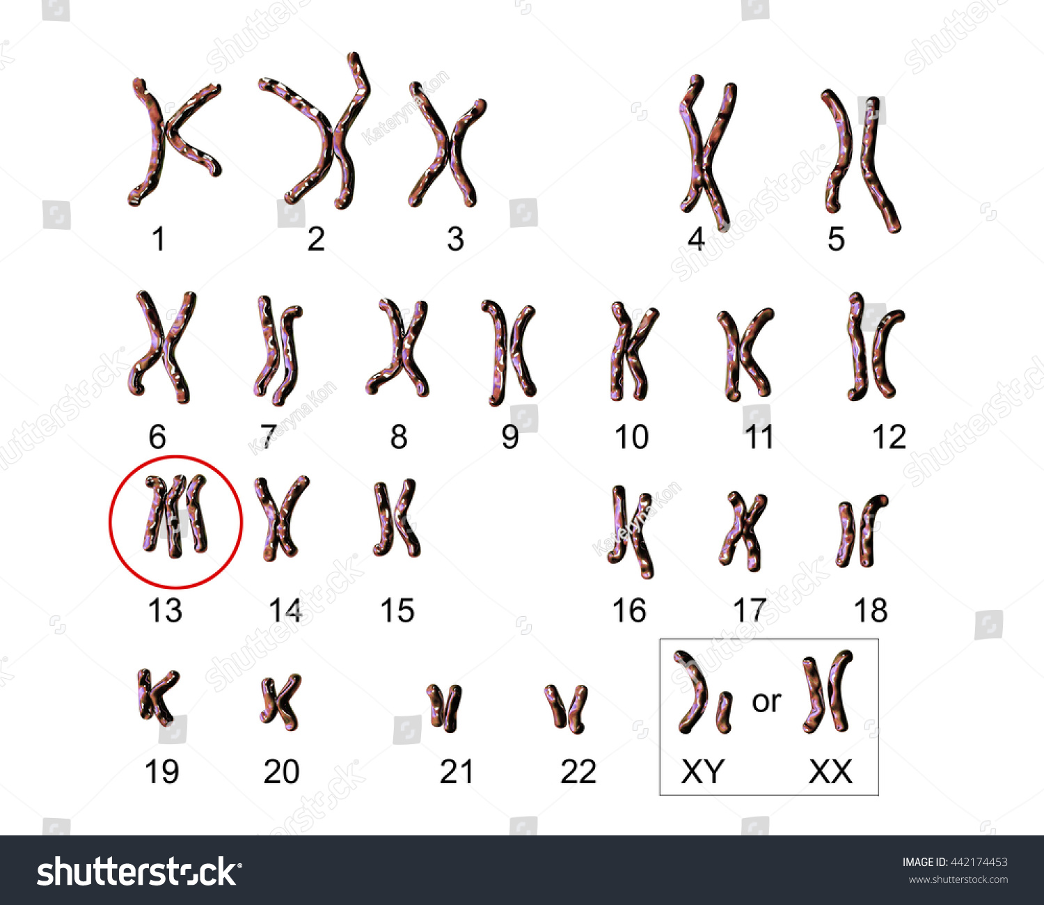 Patausyndrome Karyotype Labeled Trisomy 13 3d Stock Illustration ...