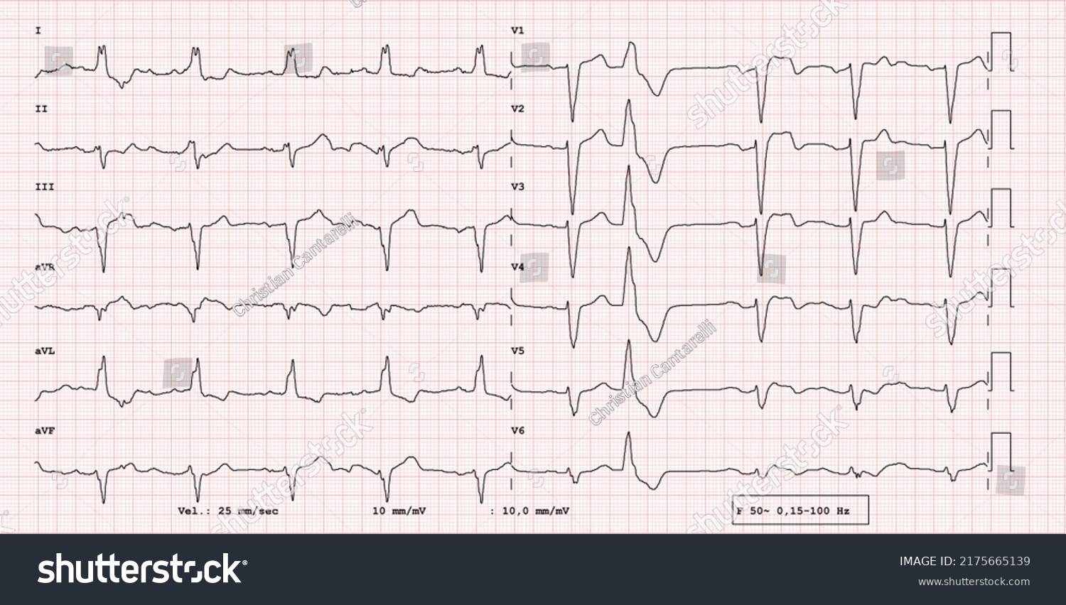 Pathological 12lead Ecg Right Branch Block Stock Illustration ...