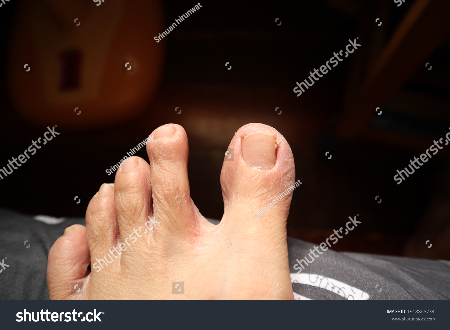 peeling-skin-rash-on-feet-must-stock-photo-edit-now-1918845734