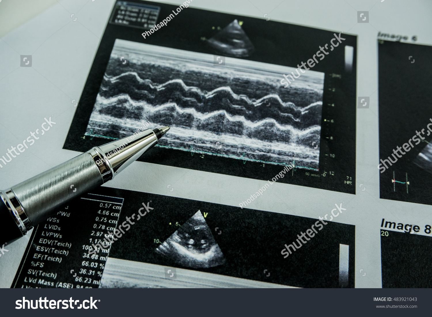 Pen On Image Result Echocardiography Ultrasound Stock Photo 483921043